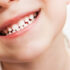 Czy dzieci mogą leczyć zęby pod narkozą