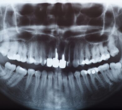 Jak przygotować się na rentgen zębów